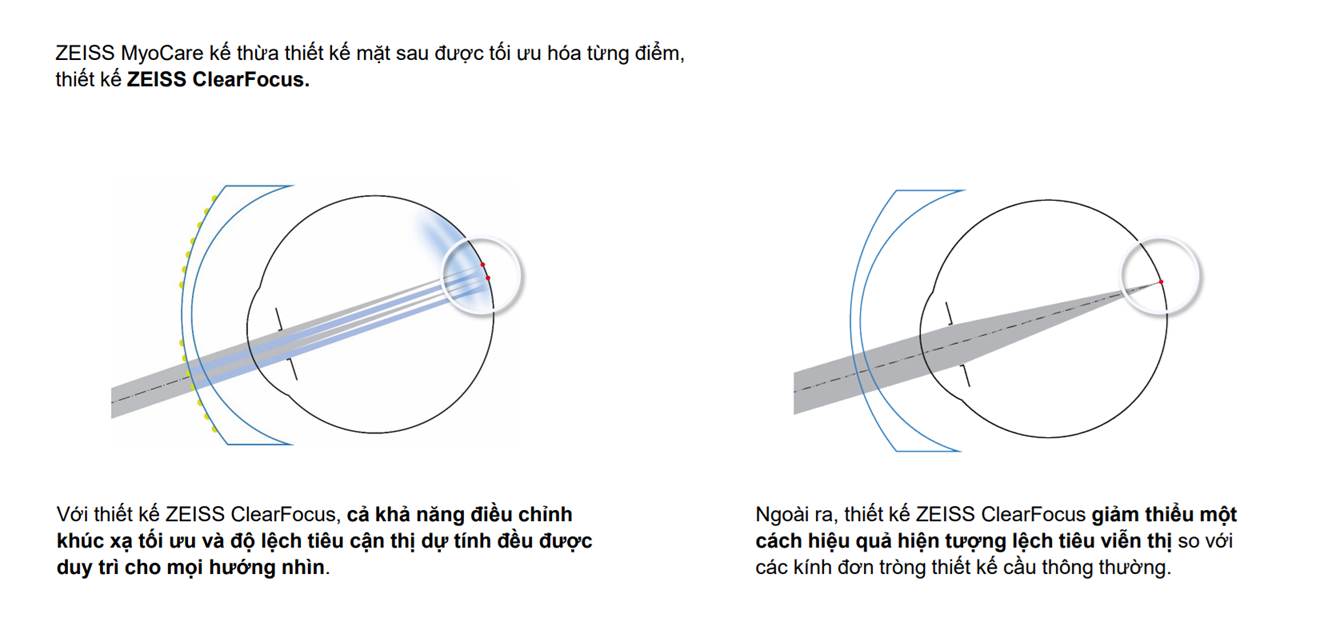 Sự Khác Biệt Giữa Tròng Kính ZEISS MyoCare và MyoCare S